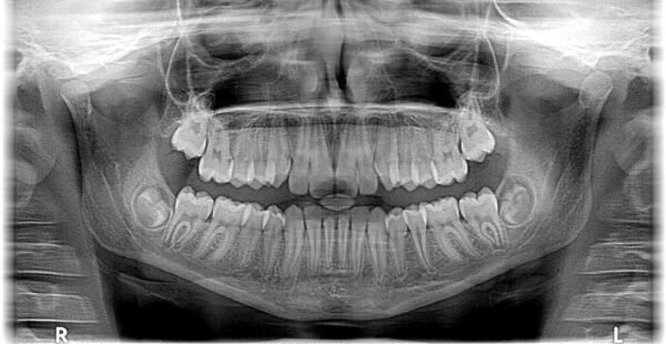 Jak działa aparat ortodontyczny?
